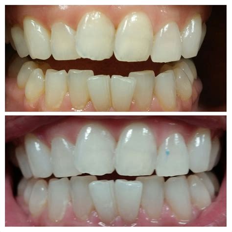 Laser Teeth Whitening Before And After Pictures Teethwalls