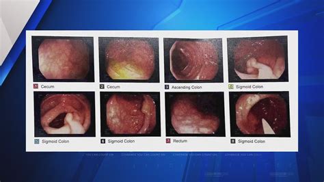 St Louis Doctors Been Telling Patients To Get Colonoscopy By Age 45