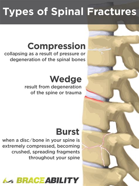 How Can I Treat A T12 Or L1 Thoracic Spinal Burst Fracture