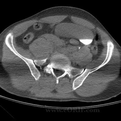 Pelvic Ring Injury ORIF 27217 | eORIF