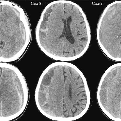 Preoperative Ct Scans Of The Acute On Chronic Subdural Hematoma Case