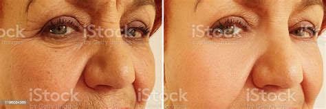 Old Woman Face Wrinkles Before And After Treatment Stock Photo