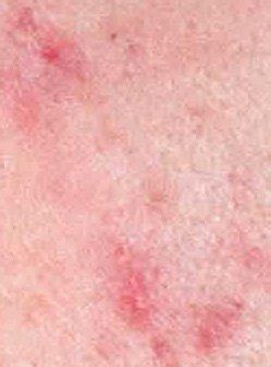 It is characterized by a visible change in the color and texture of the skin, this condition oatmeal is an effective home remedy for skin rash; Pictures of Skin Rashes - Skin Rash Images - GLISC.com