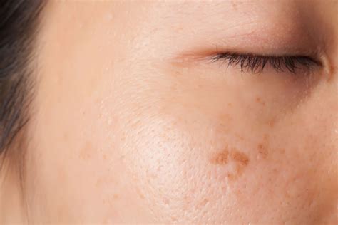 What Causes Brown Spots On The Skin Beverly Hills Md