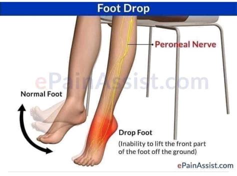 Peroneal Nerve Foot Drop