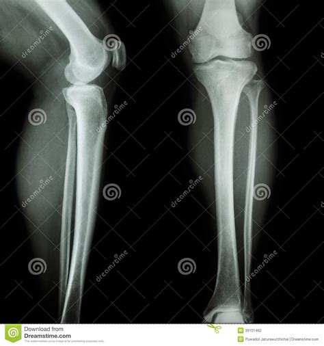 There mild or borderline patella alta. Film X-ray Leg & Knee AP/lateral Stock Photo - Image: 39101462