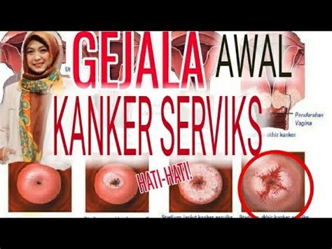 Gejala kanker serviks pada tahap awal umumnya sangat sulit dideteksi. GEJALA AWAL KANKER SERVIKS. HATI-HATI DENGAN GEJALA YANG ...