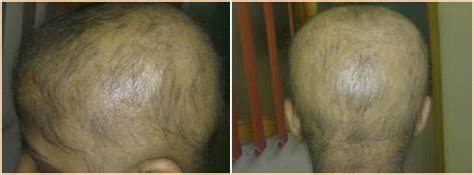 It is most predominant in women of caucasian ethnicity, occurring in 3 to 12 percent chronic telogen effluvium is when excessive hair loss continues for at least 6 months without any noticeable widening of hair loss in the scalp region. Derma Vision - Centre for Skin, Hair, Nail & Cosmetic Care