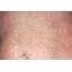 Urticaria Rash On Abdomen Photograph By Dr P Marazzi/science Photo Library