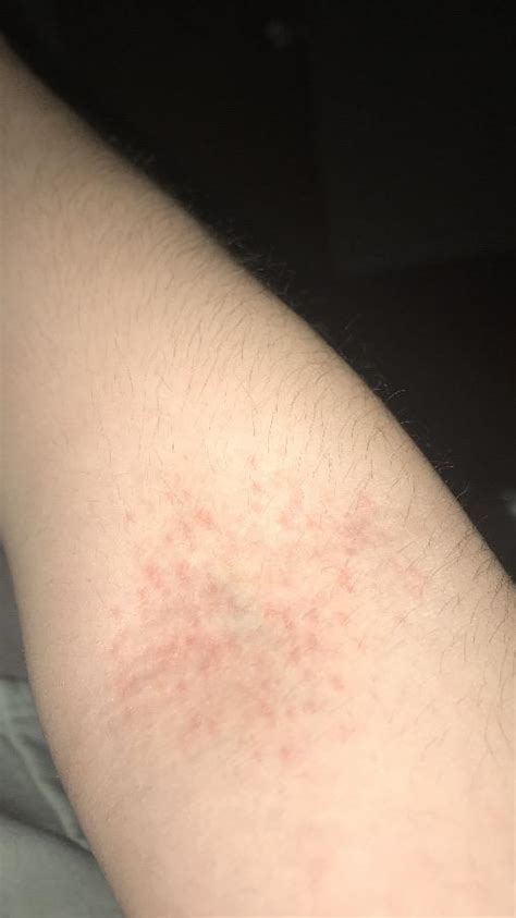 I Have This Rash It And Its Not Itchy Help Me Please It Hasnt Gone