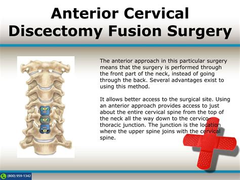 Ppt Anterior Cervical Discectomy Fusion Spine Tech Powerpoint