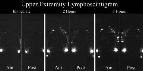 The Third Circulation Radionuclide Lymphoscintigraphy In The
