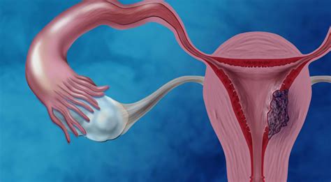Endometriosis is characterized by the presence of endometrium and endometrial stroma outside the uterine cavity, in. Endometriosis بالعربي - Ù…Ø±ÙƒØ² ØµØ­Ø© Ø§Ù„Ù…Ø±Ø£Ø© ÙˆØ§Ù ...