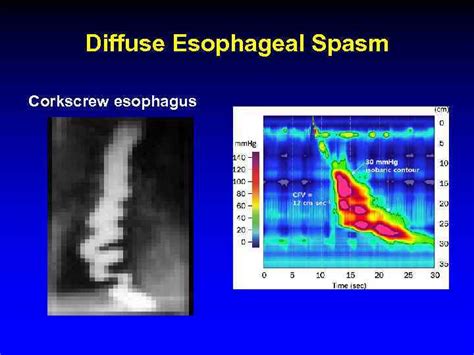Diffuse Esophageal Spasm Manometry