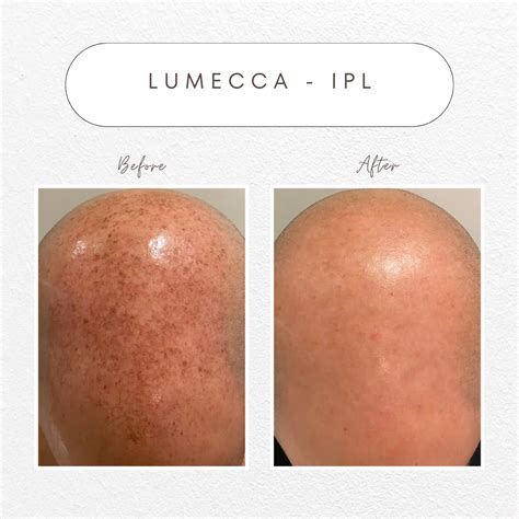 Lumecca Ipl Clear Skin Aspire Care Clinic