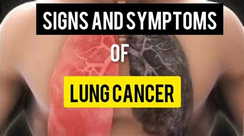 Lung Cancer Early Signs And Symptoms Of Lung Cancer You Shouldnt