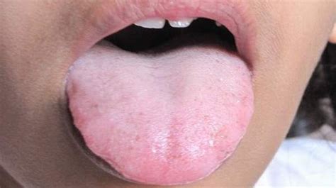 White Tongue Causes White Tongue Causes White Tongue Tongue