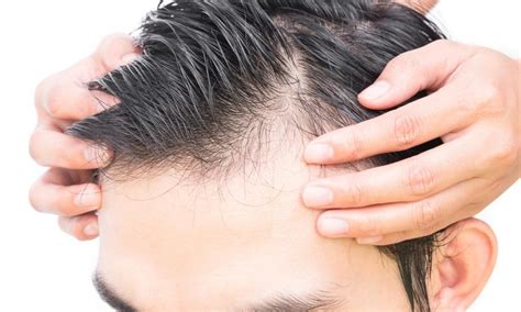 All You Need To Know About Male Pattern Baldness And Its Treatment