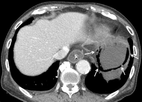 Ct Finding A Contrast Enhanced Abdominal Ct Scan Shows Diffuse Wall
