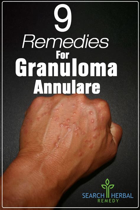 9 Natural Treatments For Granuloma Annulare How To Treat Granuloma