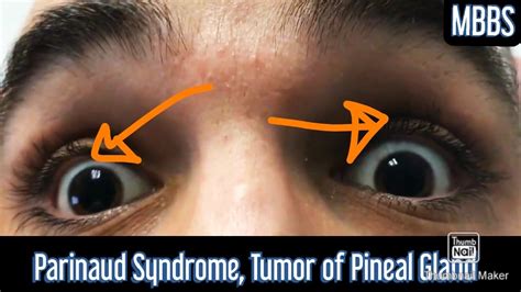 Parinaud Syndrome Tumor Of Pineal Gland Mbbs Medicine Neetpg