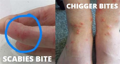 The Complete Guide To Chiggers Vs Scabies Y L P C