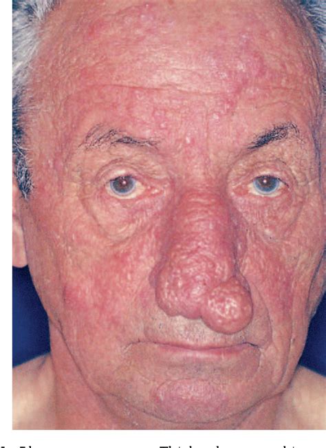 Figure 3 From Continuing Medical Education Rosacea I Etiology