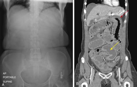 Small Bowel Obstruction Radiology Key