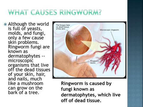 Ringworm Diagram