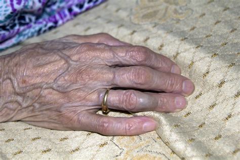 It can also be caused by a restriction of blood vessels in the hand. Hand Vein Causes and Therapy Options