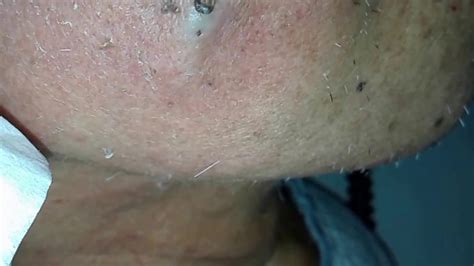 Hard Recurring Pimple On Right Cheek Youtube