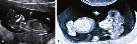 Ultrasound Screening For Fetal Abnormalities In The First Trimester