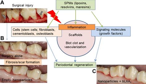 Inflammation And Periodontal Regeneration Pocket Dentistry