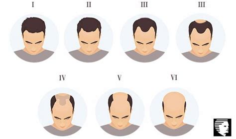 Male Pattern Baldness Stages Slidesharedocs