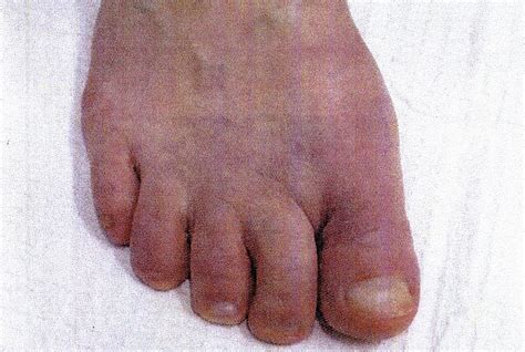 Bunion Before And After Surgery Results Northwest Surgery Center