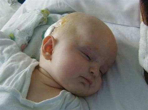Hydrocephalus In Children Causes Identification Signs And Prevention