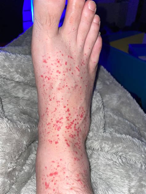 A Lot Of Red Spots On Feet Anyone Know What This Might Be I Have Them