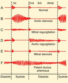 The best a soft murmur alternatives are mynoise, noisli and tide (by moreless). Patent ductus arteriosus - Wikipedia