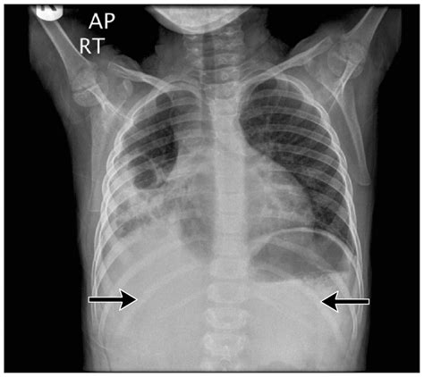 Severe Necrotizing Pneumonia In A Child With Pandemic H1n1 Influenza