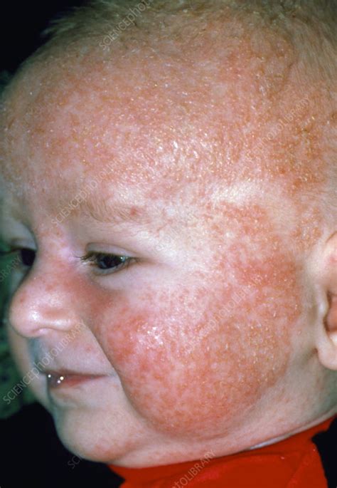 Eczema Rash On Babys Face And Head Stock Image M150