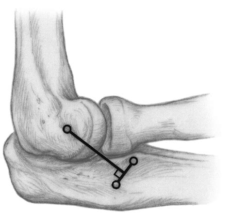 Ligamentous Repair And Reconstruction For Posterolateral Rotatory