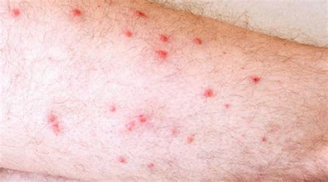 Red Itchy Bumps On Legs Causes And Relief Treatments Skincarederm