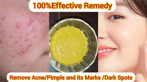 How To Remove Acne Pimple On Face Overnight At Home Naturally Acne