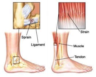 Sprains And Strains What S The Difference Hohman Rehab And Sports Therapy