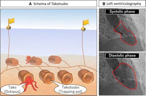 breve racconto sulla sindrome di tako tsubo storia della medicina sito and blog