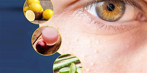 8 Effective Natural Remedies To Get Rid Of Bumps Around Your Eyes