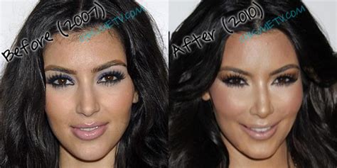 Kim Kardashian Plastic Surgery Before And After Nose Job Botox And