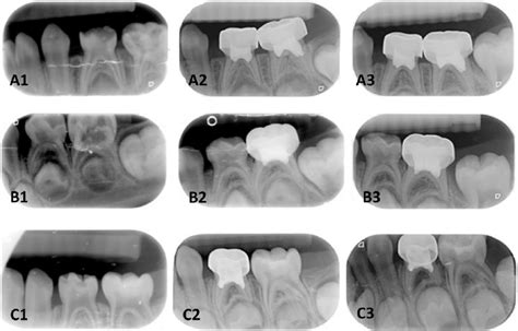 Periapical Radiographs Of Successful Cases A Initial A1 9 Month