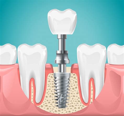How To Help A Loose Dental Implant Dr Eric Marsh DMD