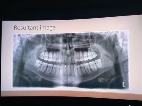 Dental Radiography Isf Flashcards Quizlet